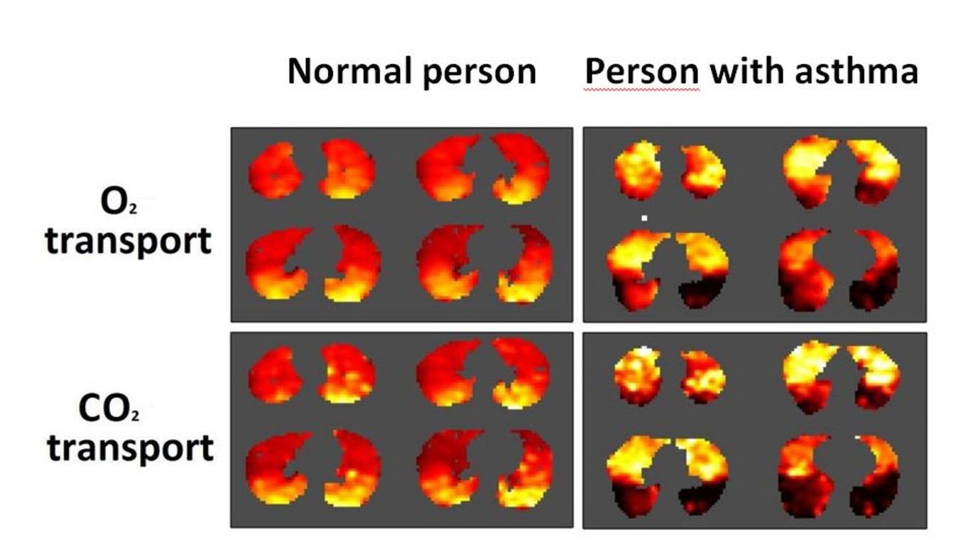 The picture shows a far better gas transport in a person with no lung diseases in contrast to a person with asthma.